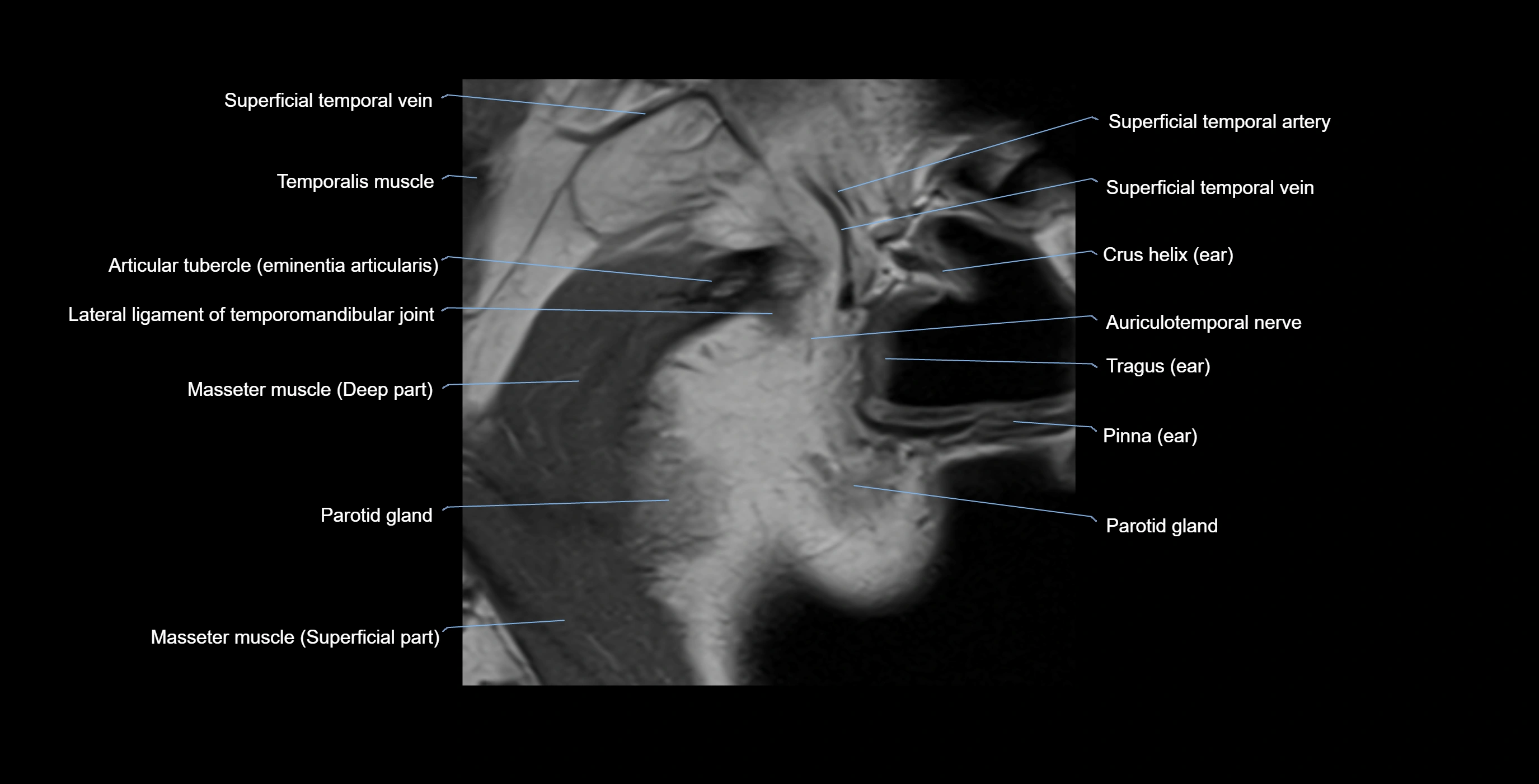 MRI TMJ sagittalclosed  mouth cross sectional 3T anatomy -img-00001-00002.webp